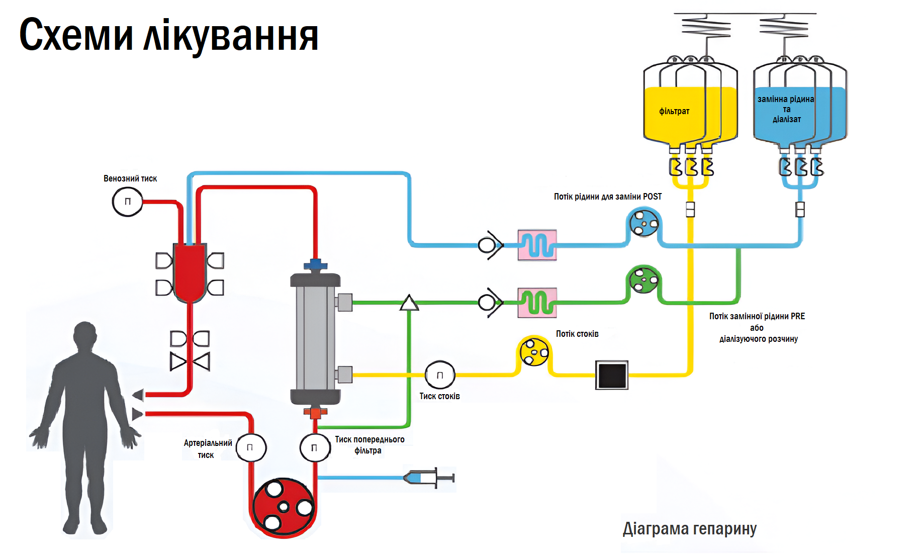 Apheresis AcuSmart Blanidas Комплектуючі для екстракорпоральної терапії Катетори для діалізу Гемоперфузія Безперервна замісна ниркова терапія Терапевтичний плазмаферез