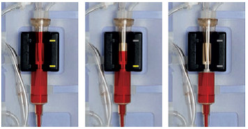 Apheresis AcuSmart Blanidas Комплектуючі для екстракорпоральної терапії Катетори для діалізу Гемоперфузія Безперервна замісна ниркова терапія Терапевтичний плазмаферез